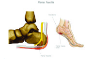 Tired, Achy, Painful Feet? ... Don’t Let PLantar Fasciitis stop you in your tracks  	By Dr. Kim C. Tran, DC